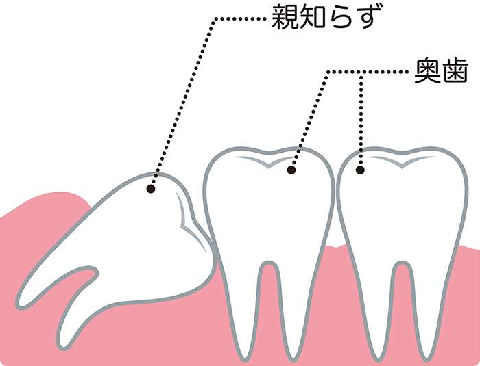 親知らず